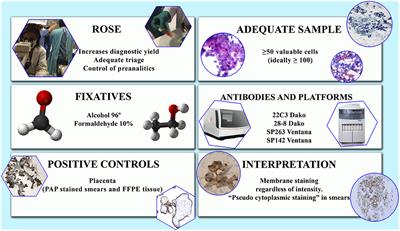 PD-L1 in Cytological Samples: A Review and a Practical Approach